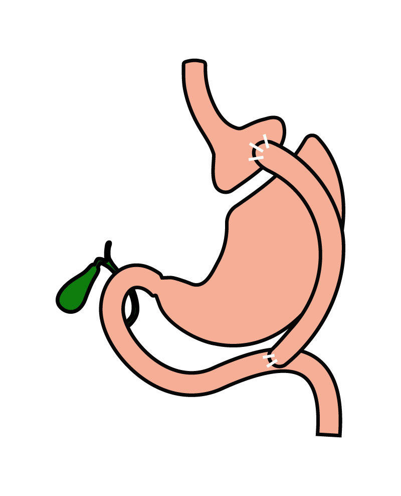 Žaludeční bypass (Roux-en-Y gastric bypass)