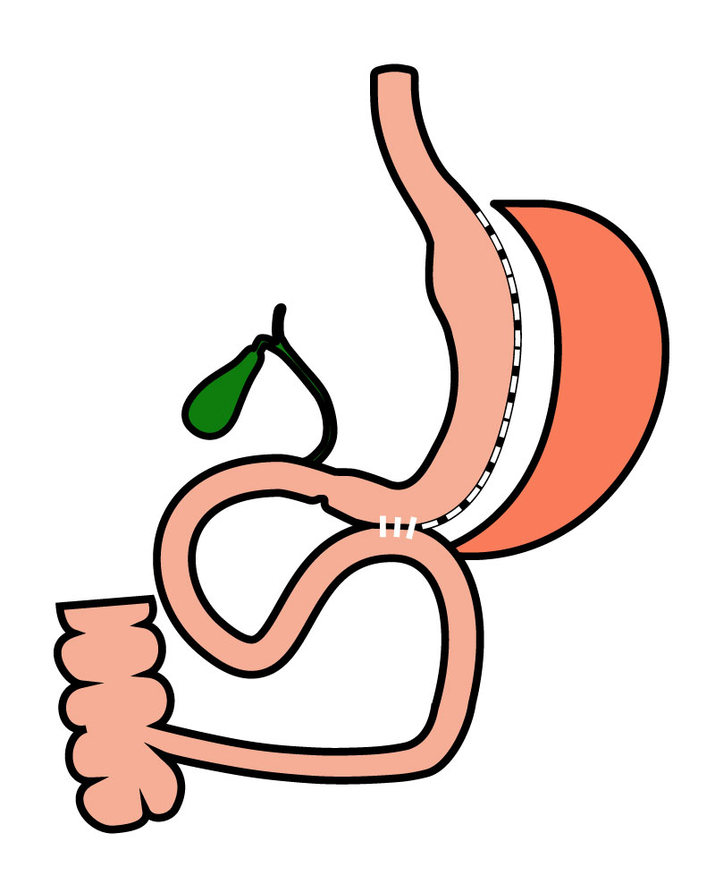 SASI bypass (Single Anastomosis Stomach-Ileal Bypass)